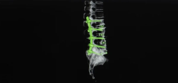 Spinal Füzyon