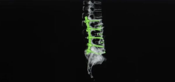 Spinal Fusion